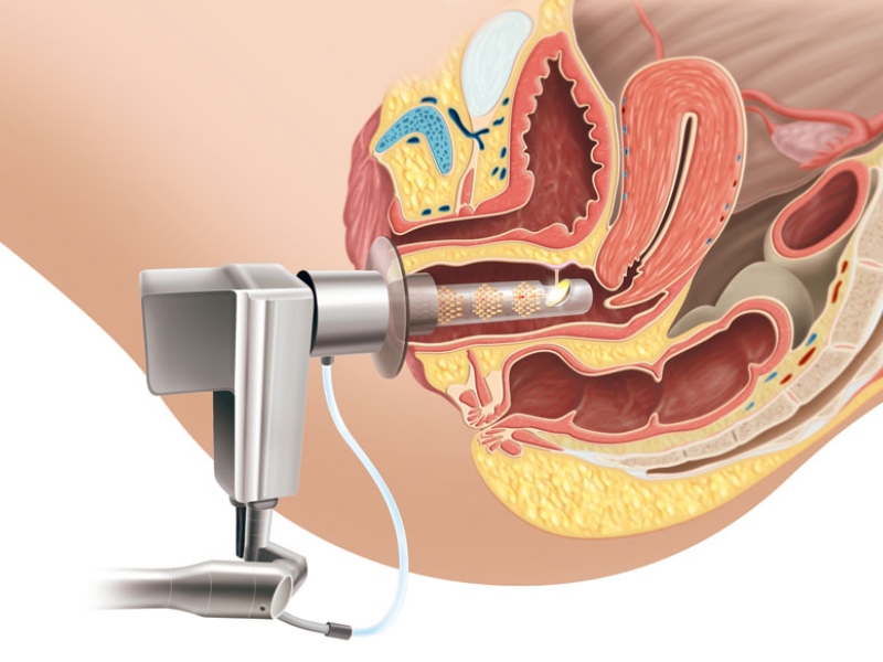 trẻ hóa vùng kín bằng laser - 4