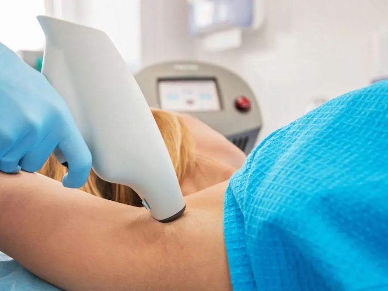 Trị hôi nách bằng laser bao nhiêu tiền - 6