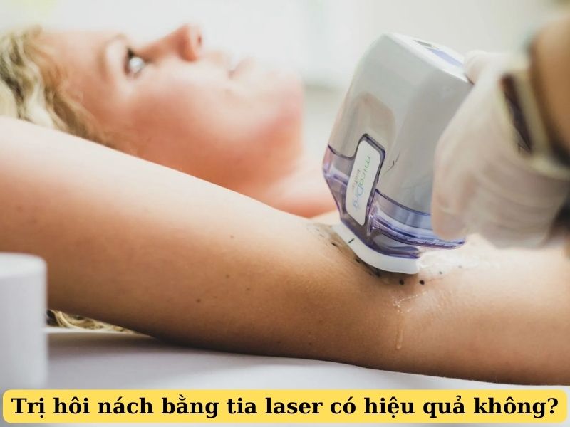 trị hôi nách bằng tia laser có hiệu quả không - 1