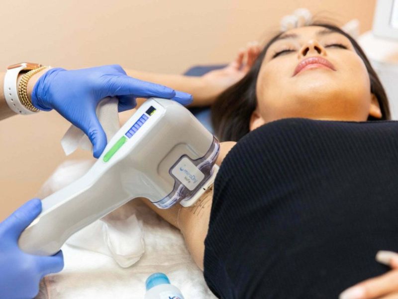 trị hôi nách bằng tia laser có hiệu quả không - 2
