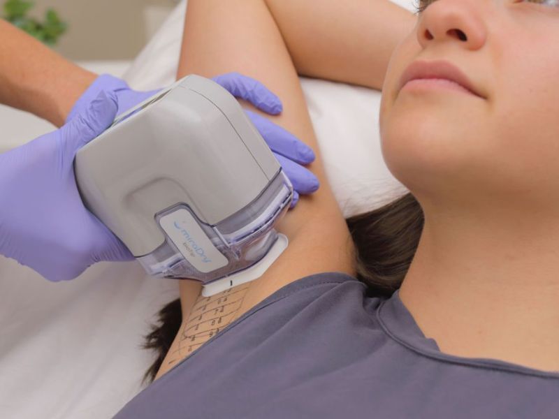 trị hôi nách bằng tia laser có hiệu quả không - 3