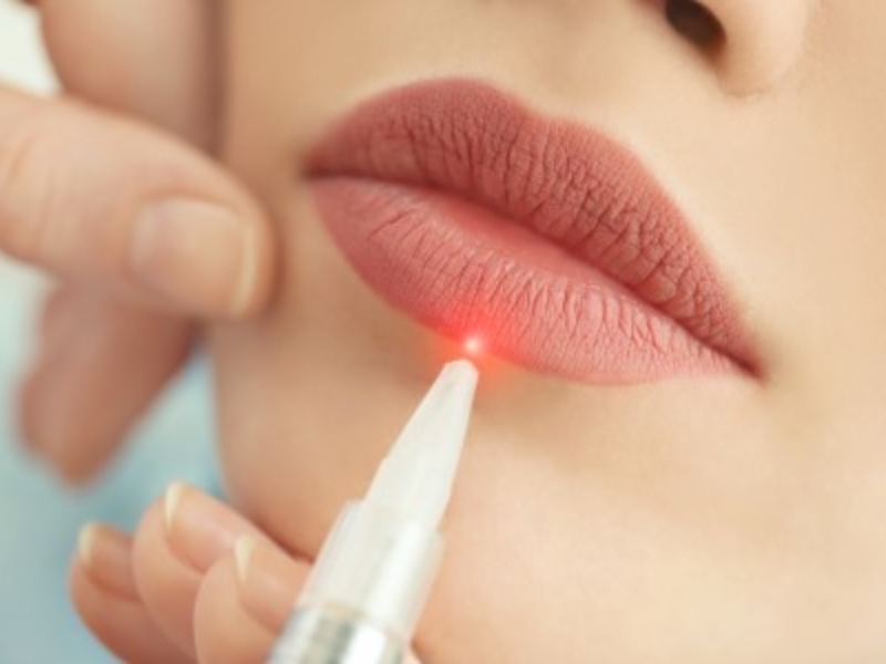 Trị môi thâm bằng laser có hiệu quả không - 1