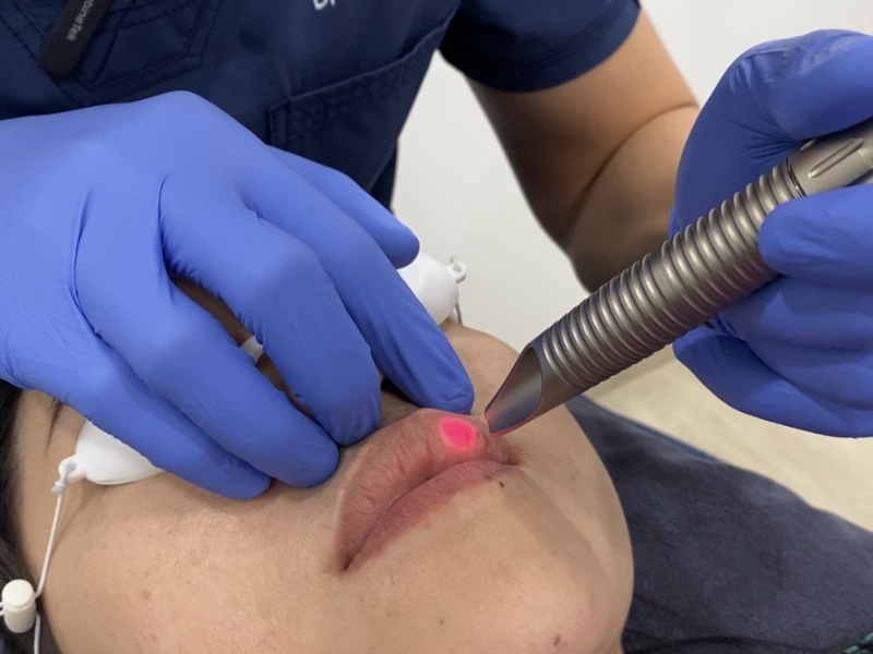Trị môi thâm bằng laser có hiệu quả không - 2