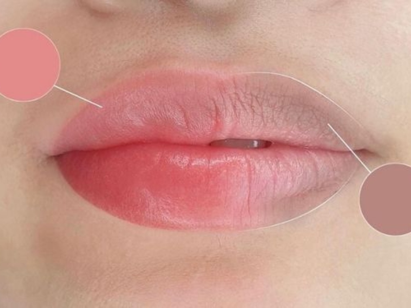 Trị môi thâm bằng laser có hiệu quả không - 6