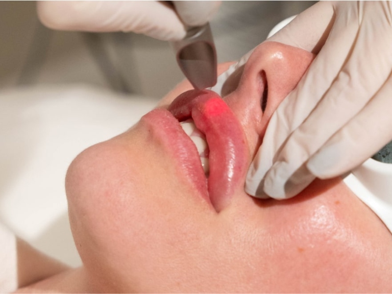 Trị môi thâm bằng laser có hiệu quả không - 7