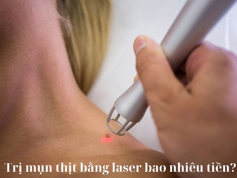 Trị mụn thịt bằng laser bao nhiêu tiền - 1