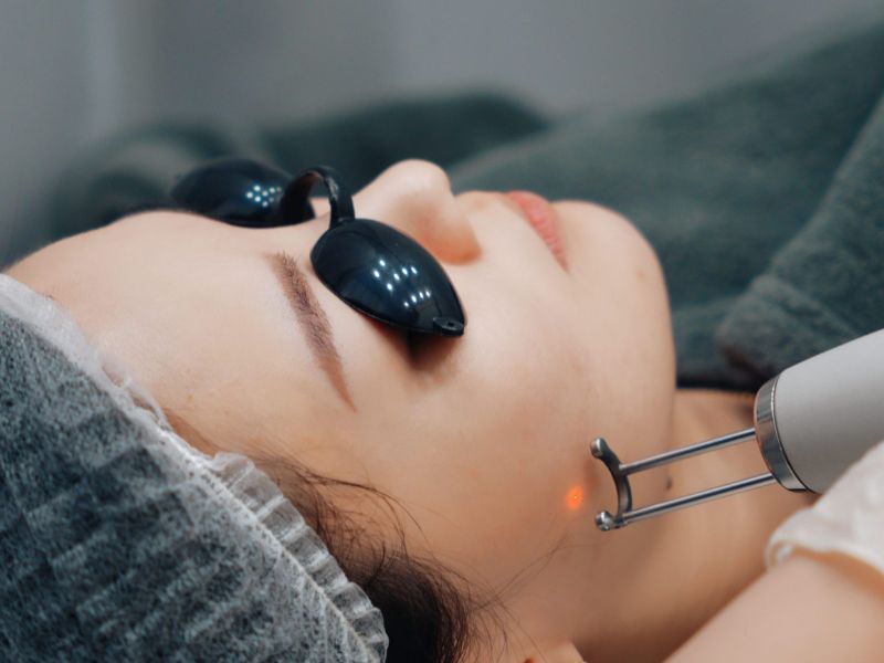 Trị mụn thịt bằng laser bao nhiêu tiền - 5