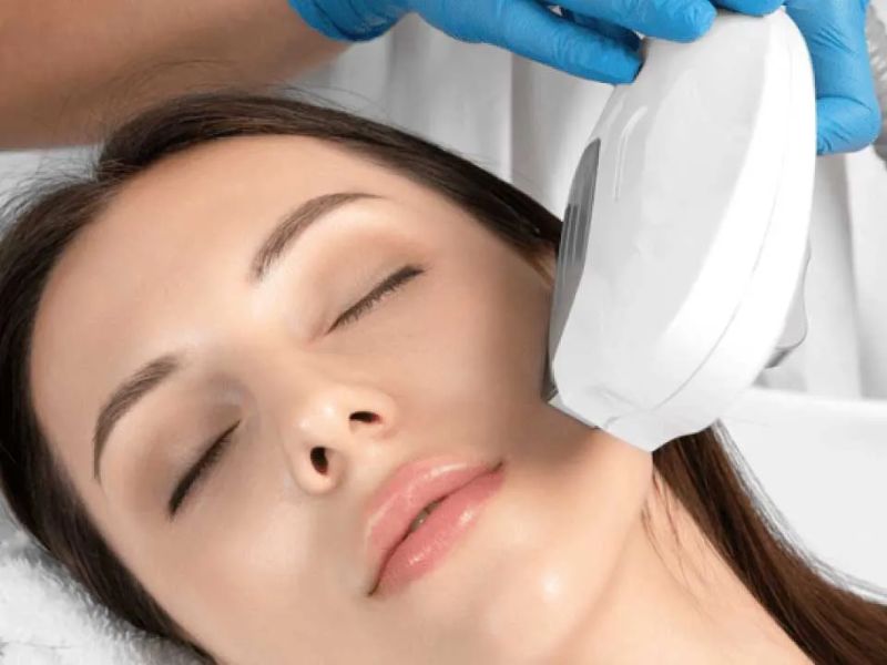 Trị nám bằng công nghệ IPL - 10