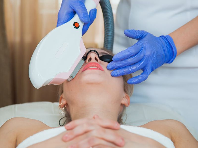 Trị nám bằng công nghệ IPL - 3
