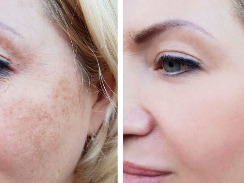 Trị nám bằng công nghệ IPL - 7