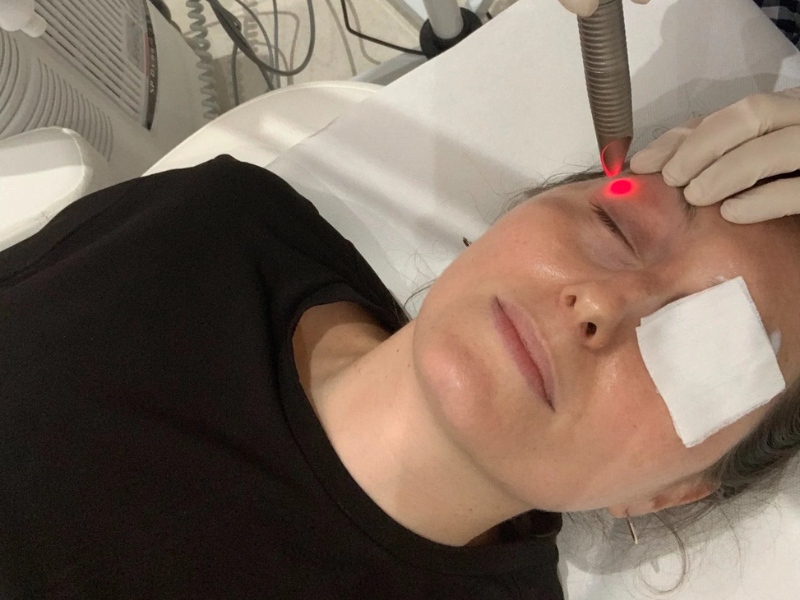 Trị thâm quầng mắt bằng laser giá bao nhiêu - 1
