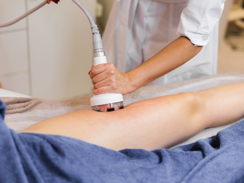 Trị rạn da bằng laser bao nhiêu tiền - 2