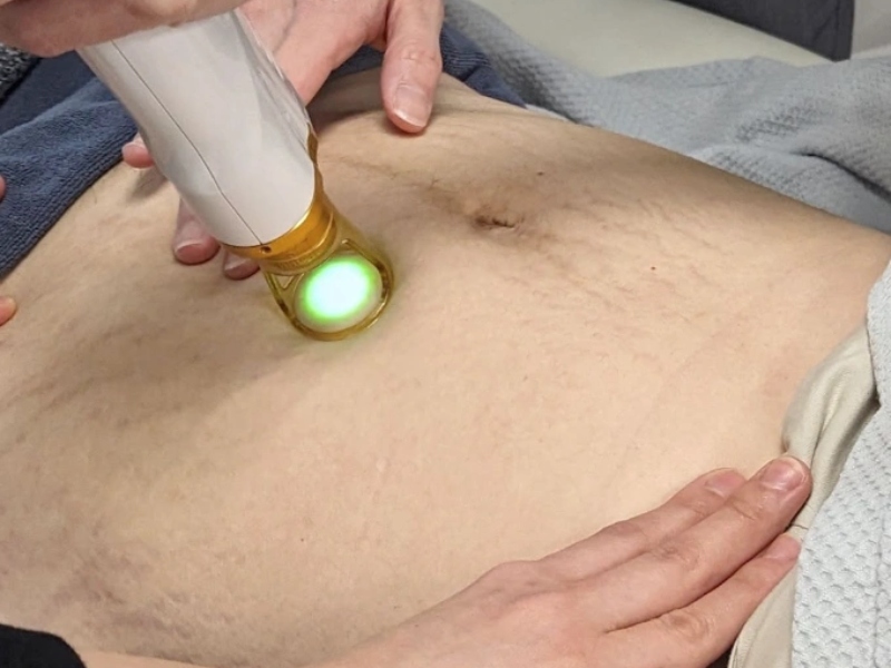 Trị rạn da sau sinh bằng laser - 5