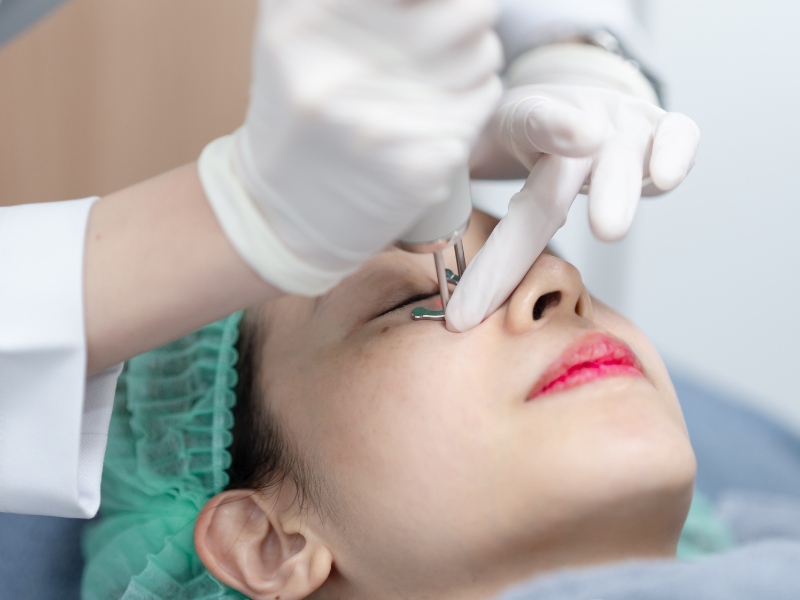 Trị thâm mắt bằng laser - 3