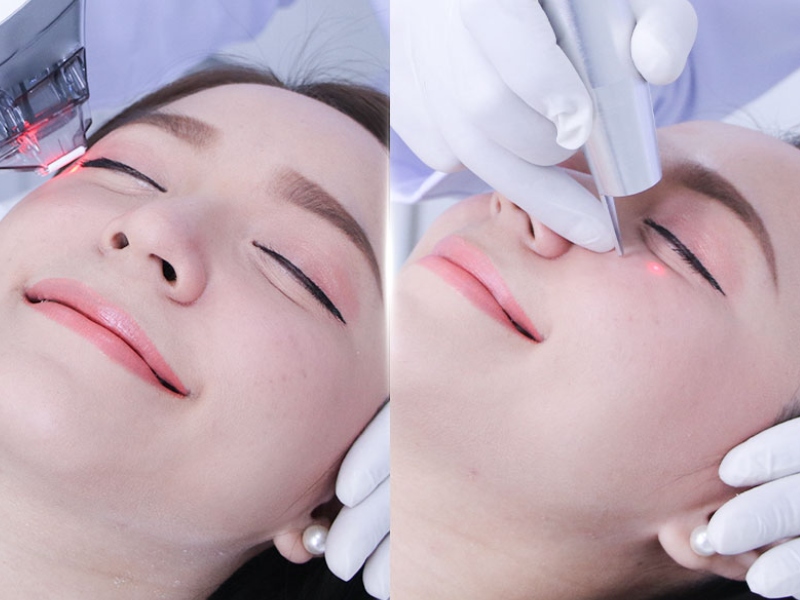 Trị thâm mắt bằng laser - 5