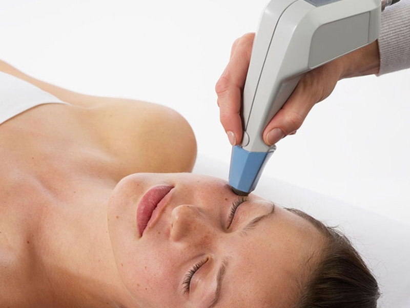 Trị thâm mắt bằng laser - 6