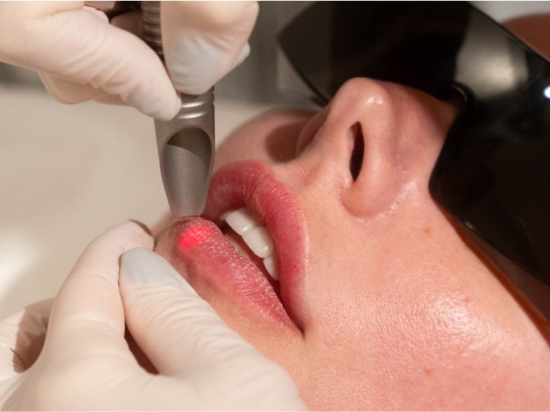 Trị thâm môi bằng laser giá bao nhiêu - 2