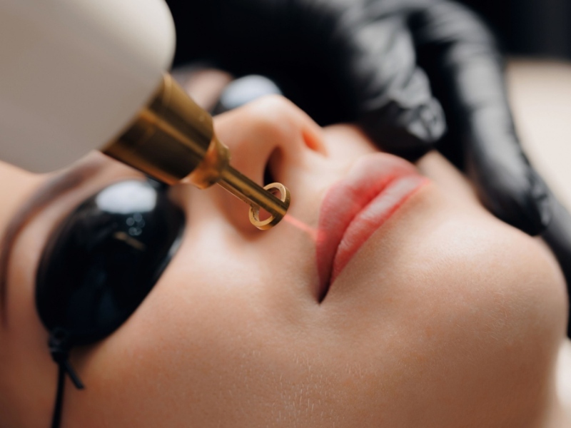 Trị thâm môi bằng laser giá bao nhiêu - 3