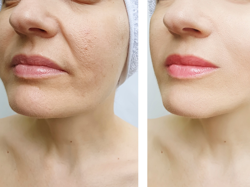 Trị thâm môi bằng laser giá bao nhiêu - 4