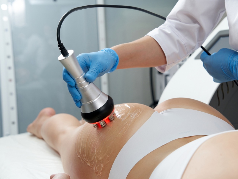 Trị thâm mông bằng laser - 7