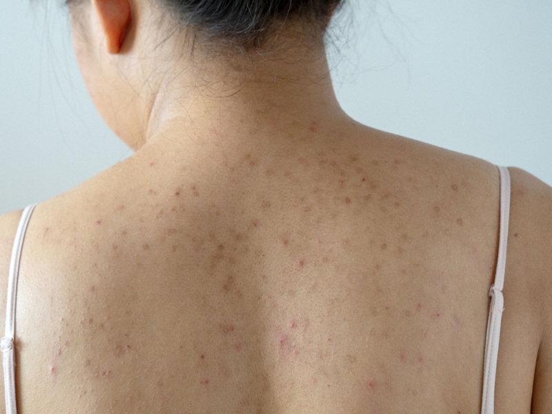 Trị thâm mụn lưng bằng laser - 1