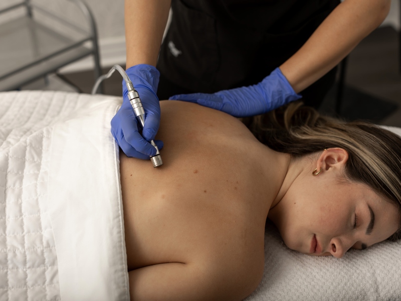 Trị thâm mụn lưng bằng laser - 2