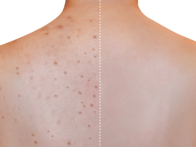 Trị thâm mụn lưng bằng laser - 3