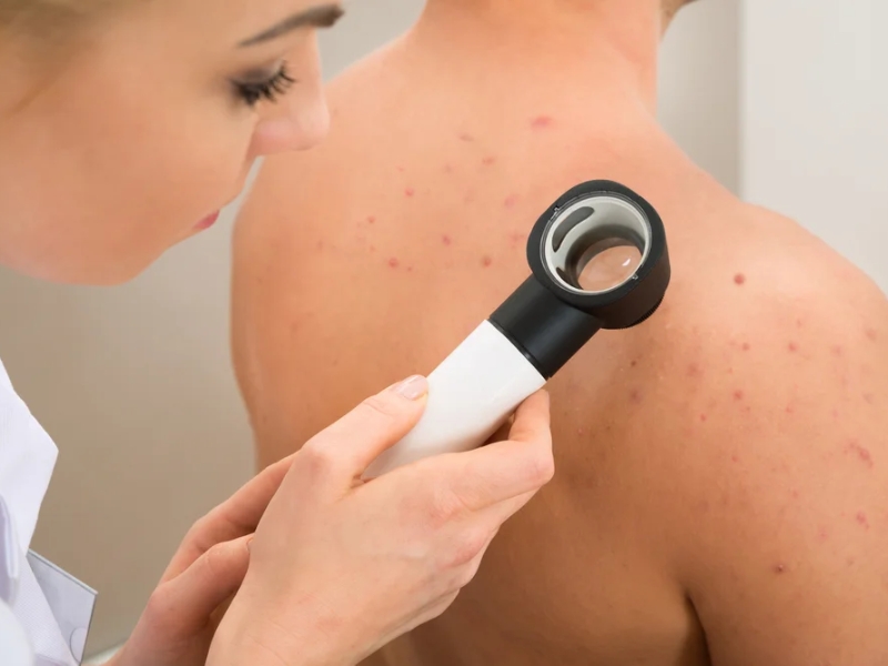 Trị thâm mụn lưng bằng laser - 4