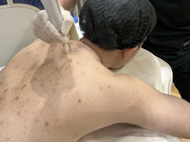 Trị thâm mụn lưng bằng laser - 5
