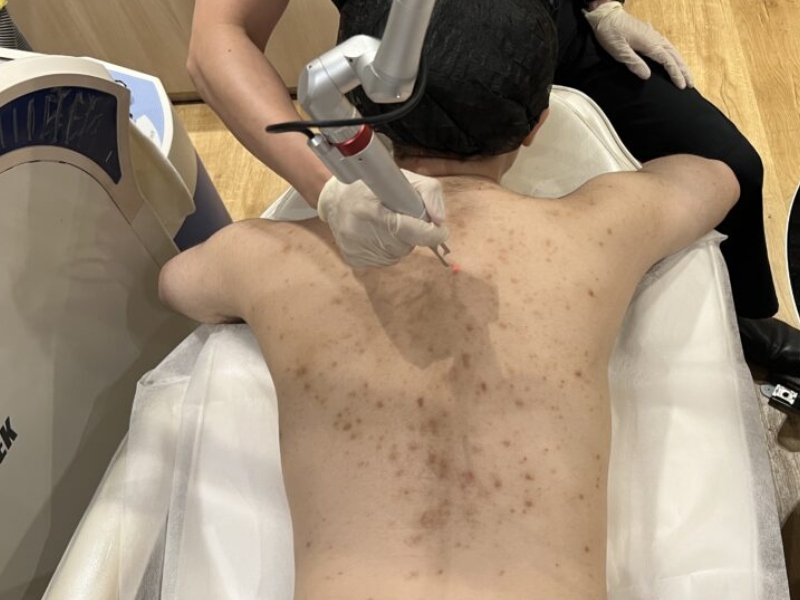 Trị thâm mụn lưng bằng laser - 6