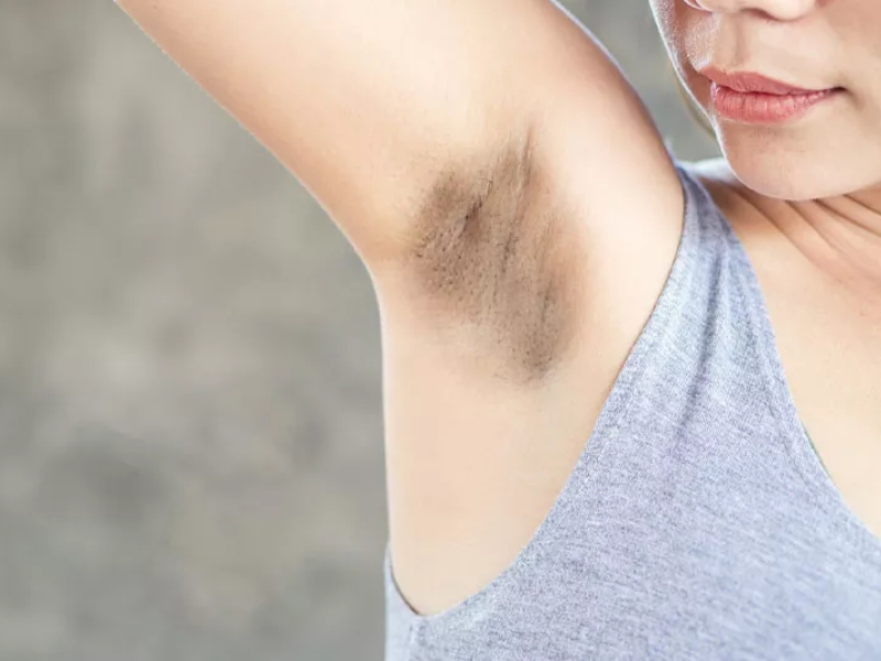 Trị thâm nách bằng laser - 1
