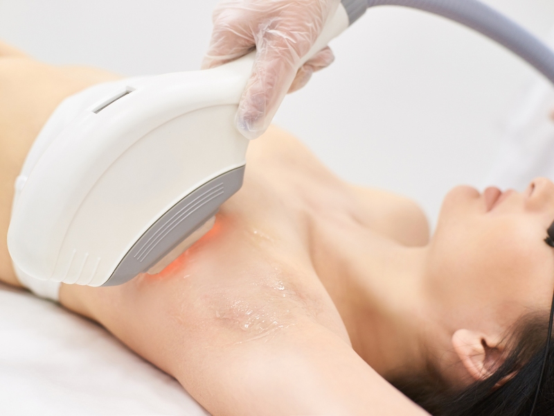 Trị thâm nách bằng laser - 3