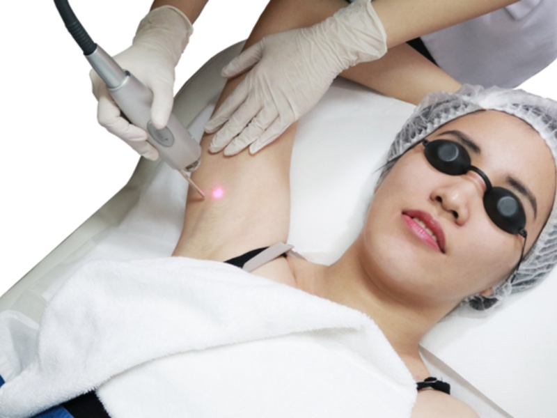 Trị thâm nách bằng laser - 7