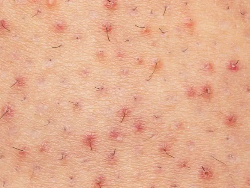 trị viêm nang lông bằng laser - 1