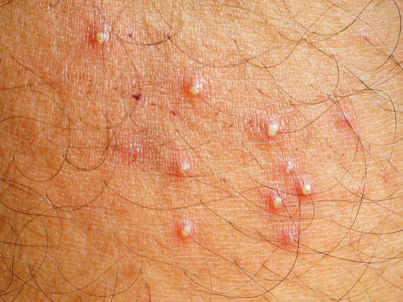 trị viêm nang lông bằng laser - 2