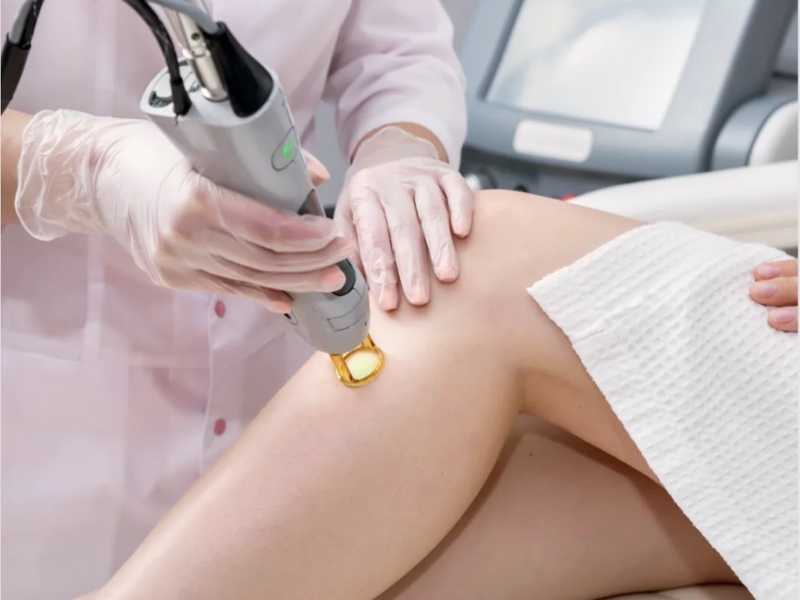trị viêm nang lông bằng laser - 4