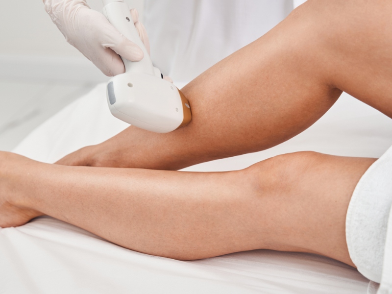 trị viêm nang lông bằng laser - 5