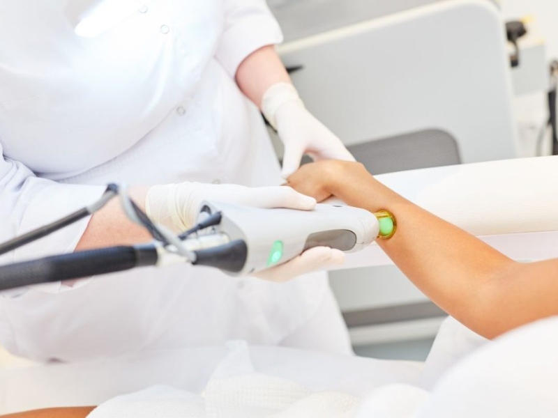 trị viêm nang lông bằng laser - 7