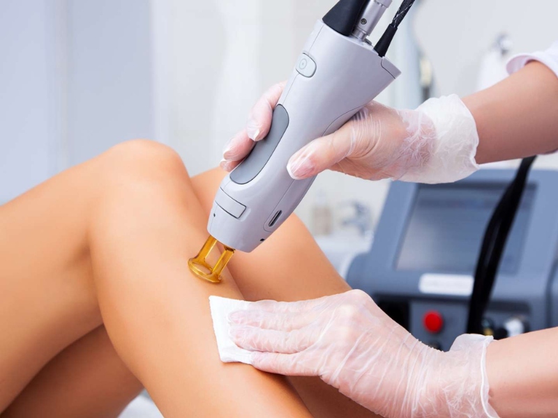 Triệt lông bằng laser - 1