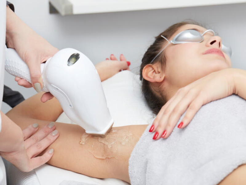 Triệt lông bằng laser - 2