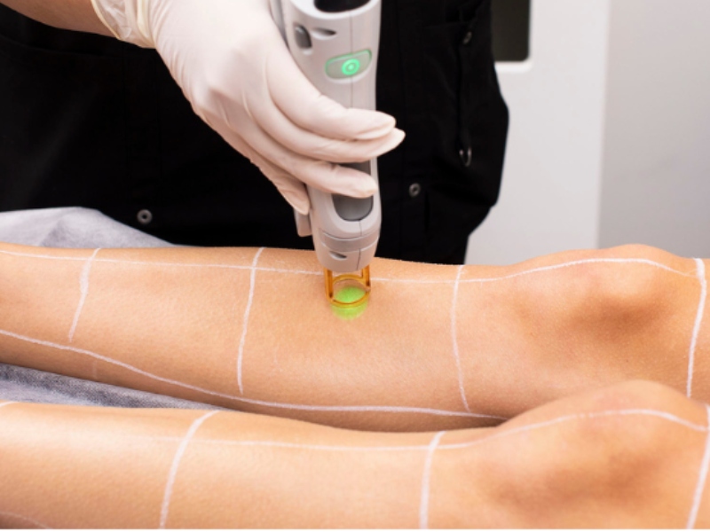 Triệt lông bằng laser - 3
