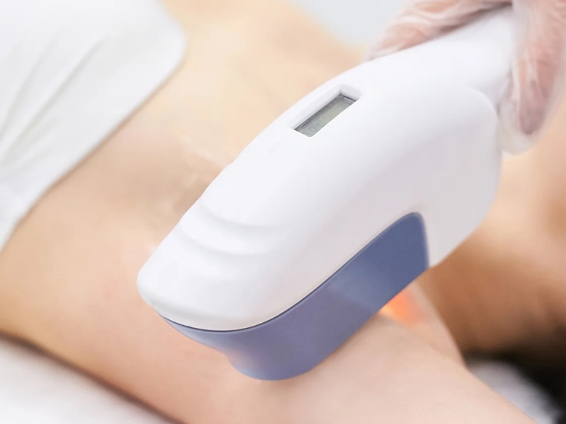 Triệt lông công nghệ ipl có tốt không - 3