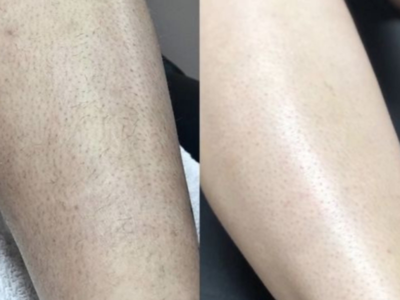 Triệt lông công nghệ ipl có tốt không - 8