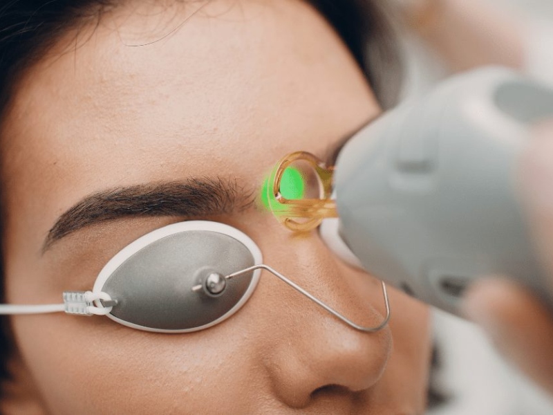 Triệt lông mặt bằng laser - 5