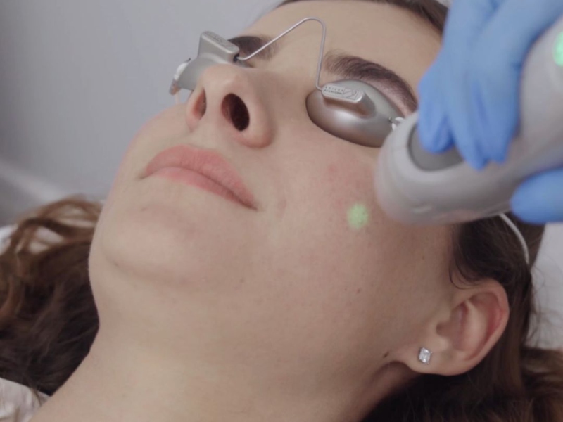 Triệt lông mặt bằng laser - 6