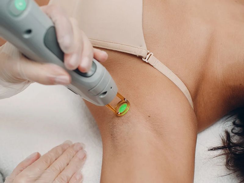 Triệt lông nách bằng tia laser - 1