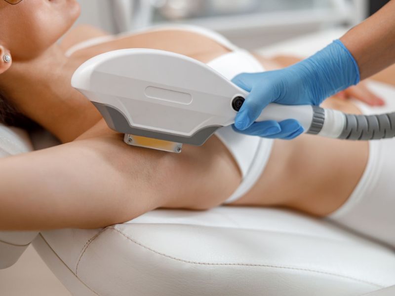 Triệt lông nách bằng tia laser - 2