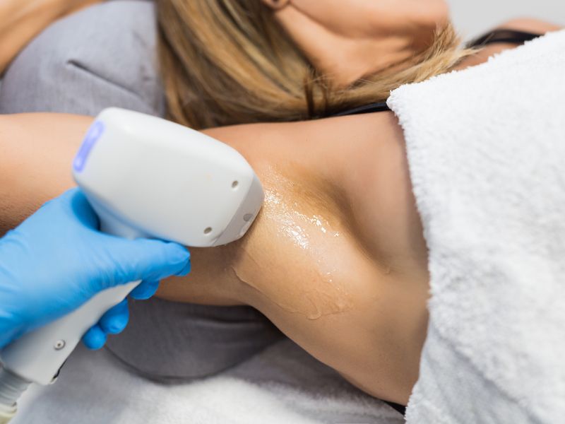 Triệt lông nách bằng tia laser - 5
