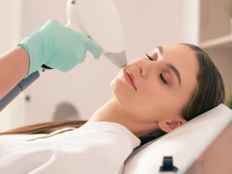 Triệt ria mép bằng laser - 2