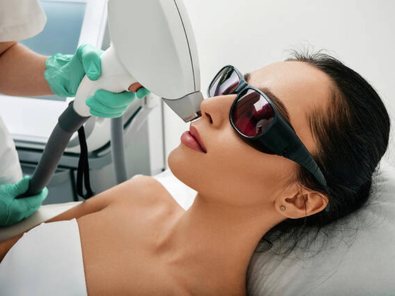 Triệt ria mép bằng laser - 4